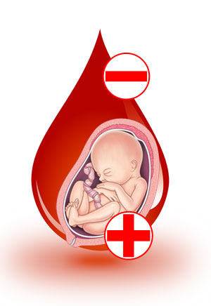 गर्भकालमा नेगेटिभ रक्तसमूहको खतरा